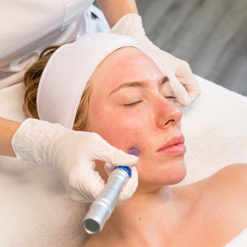 Microneedling